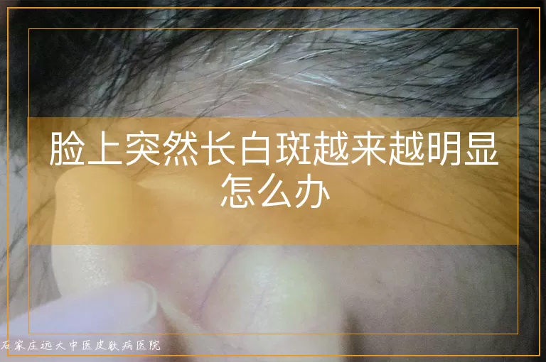 脸上突然长白斑越来越明显怎么办