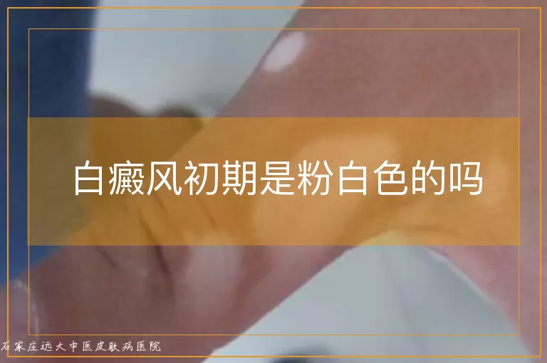 白癜风初期是粉白色的吗