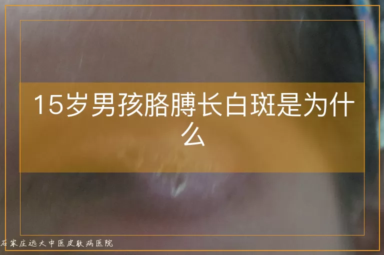 15岁男孩胳膊长白斑是为什么
