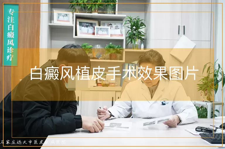 白癜风植皮手术效果图片