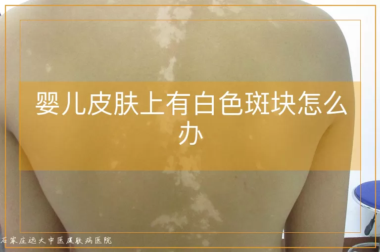 婴儿皮肤上有白色斑块怎么办