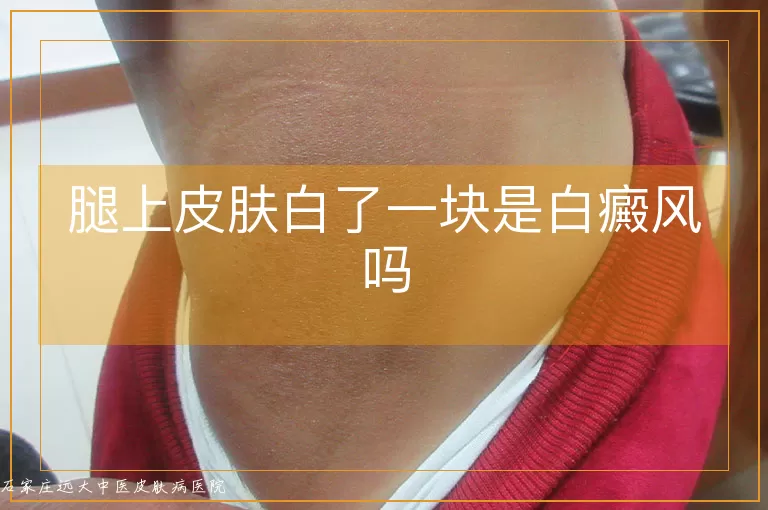 腿上皮肤白了一块是白癜风吗