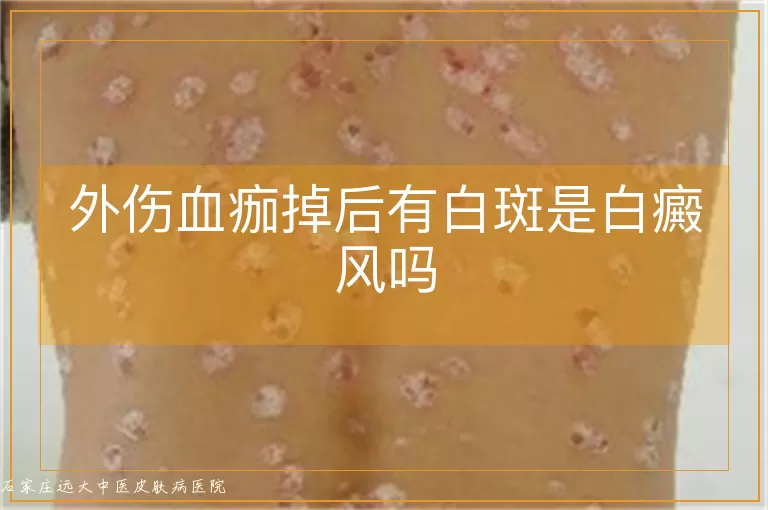 外伤血痂掉后有白斑是白癜风吗