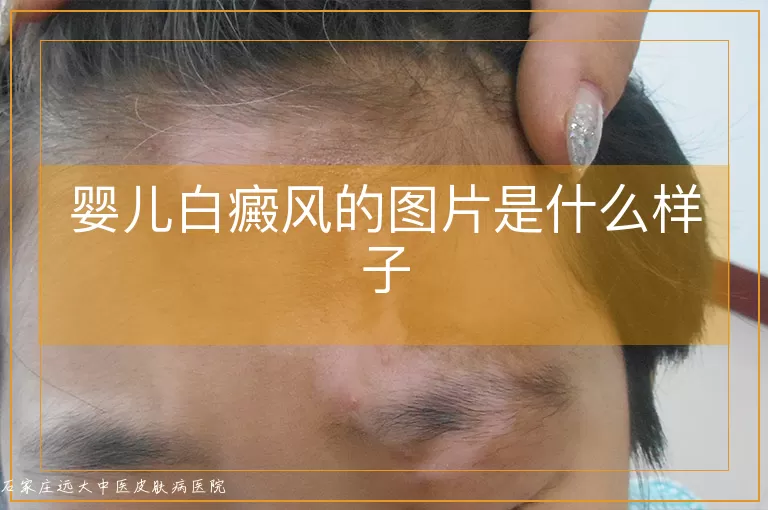 婴儿白癜风的图片是什么样子