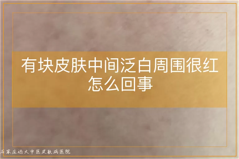 有块皮肤中间泛白周围很红怎么回事