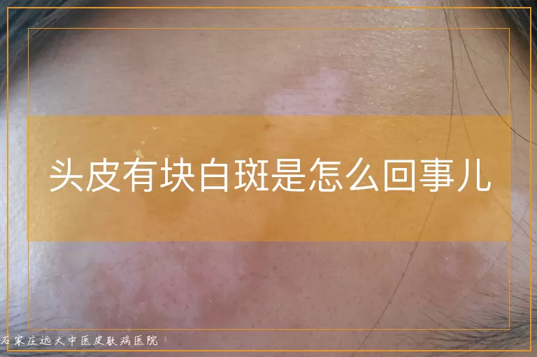 头皮有块白斑是怎么回事儿