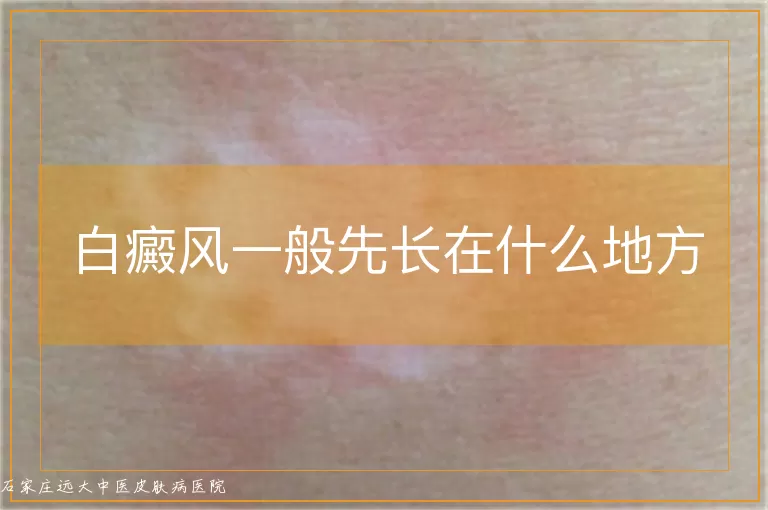 白癜风一般先长在什么地方