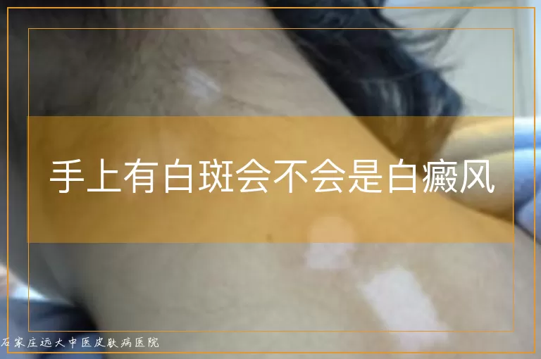 手上有白斑会不会是白癜风