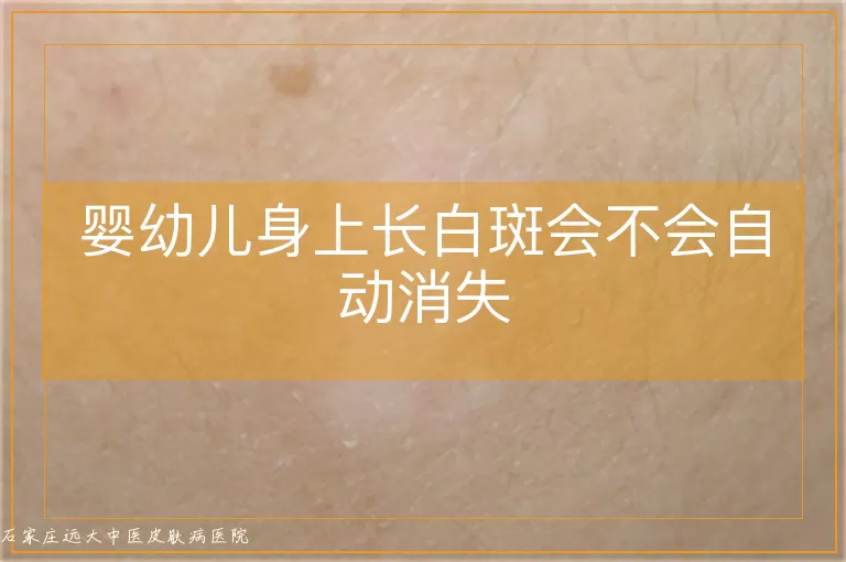 婴幼儿身上长白斑会不会自动消失