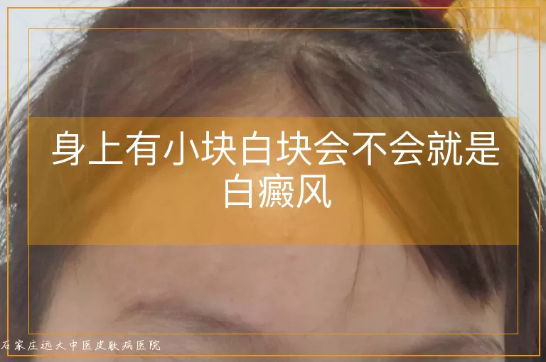 身上有小块白块会不会就是白癜风