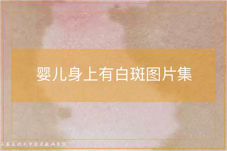 婴儿身上有白斑图片集