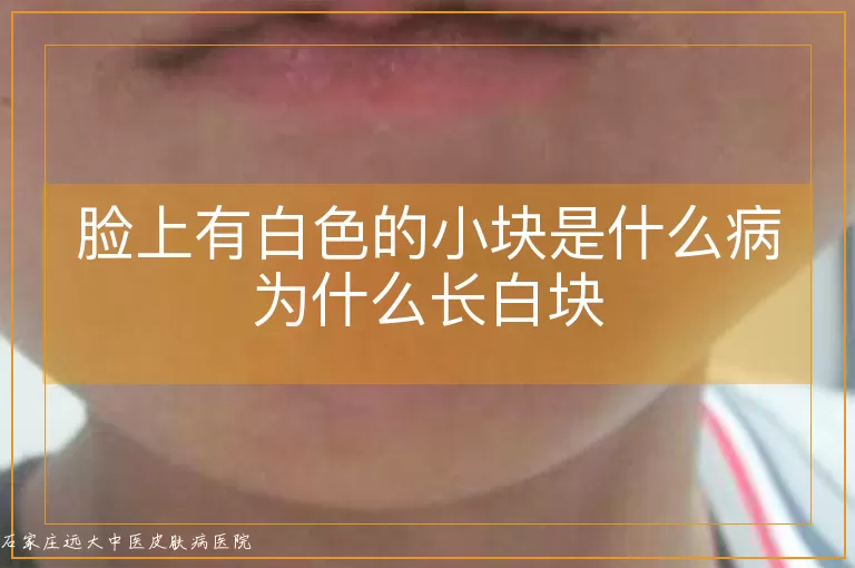 脸上有白色的小块是什么病为什么长白块