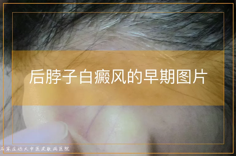 后脖子白癜风的早期图片
