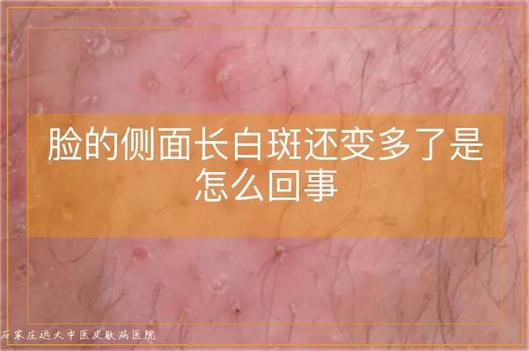 脸的侧面长白斑还变多了是怎么回事