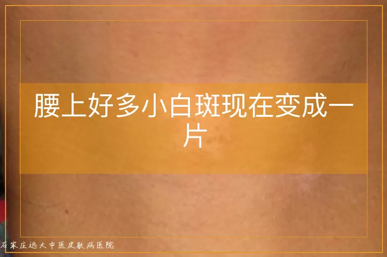 腰上好多小白斑现在变成一片