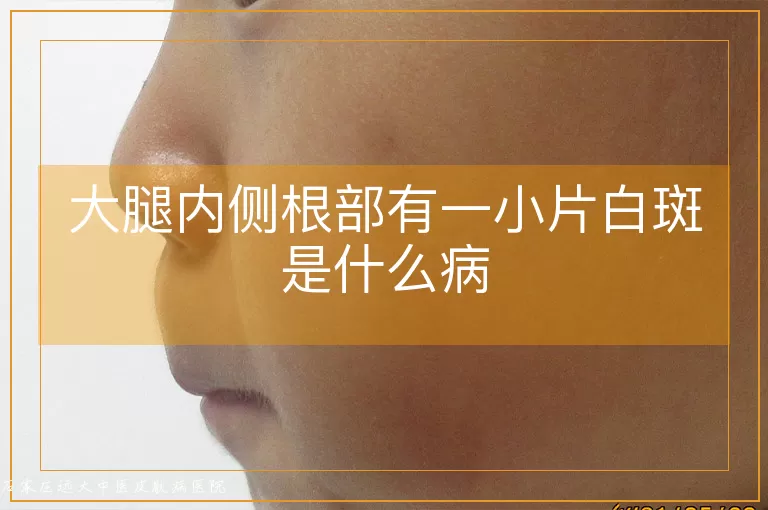 大腿内侧根部有一小片白斑是什么病