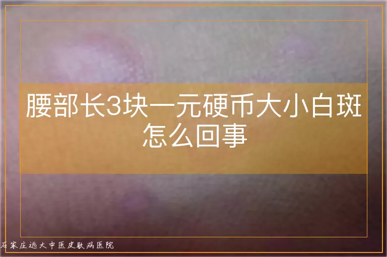 腰部长3块一元硬币大小白斑怎么回事