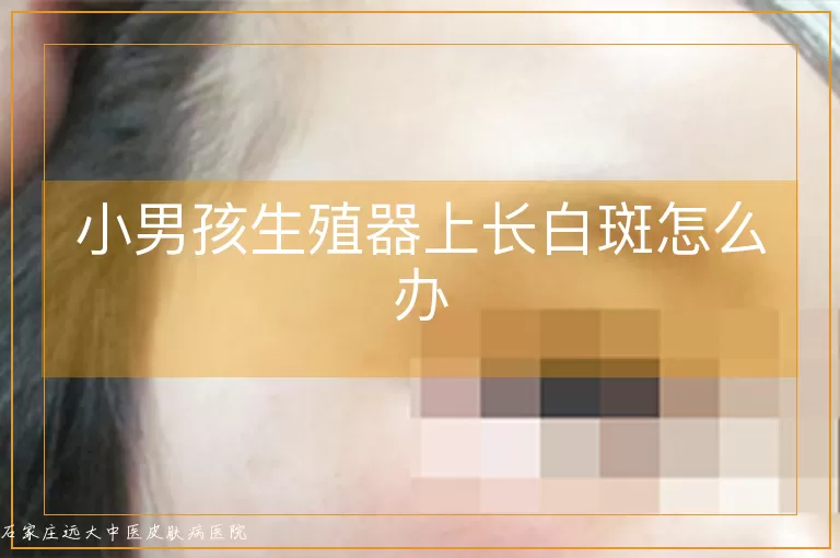 小男孩生殖器上长白斑怎么办