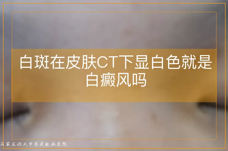 白斑在皮肤CT下显白色就是白癜风吗