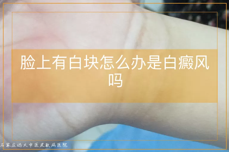 脸上有白块怎么办是白癜风吗