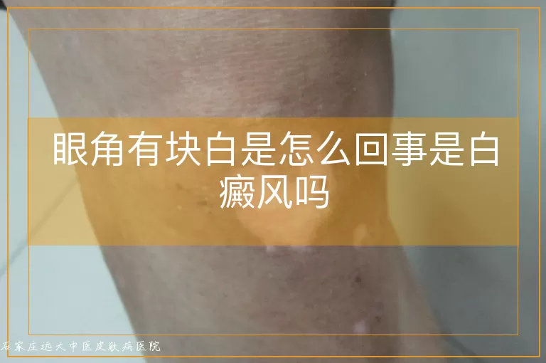 眼角有块白是怎么回事是白癜风吗