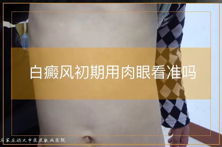 白癜风初期用肉眼看准吗