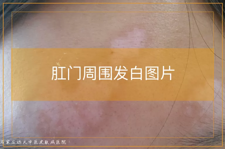 肛门周围发白图片