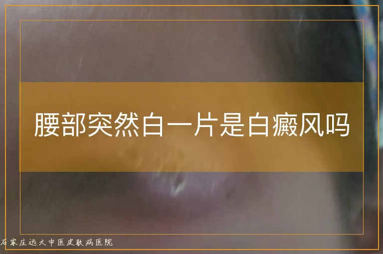 腰部突然白一片是白癜风吗
