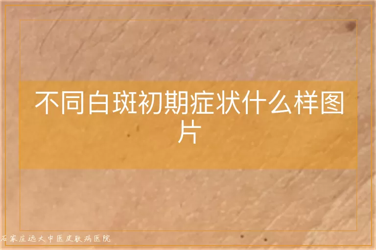 不同白斑初期症状什么样图片