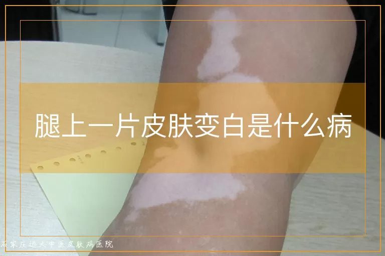 腿上一片皮肤变白是什么病