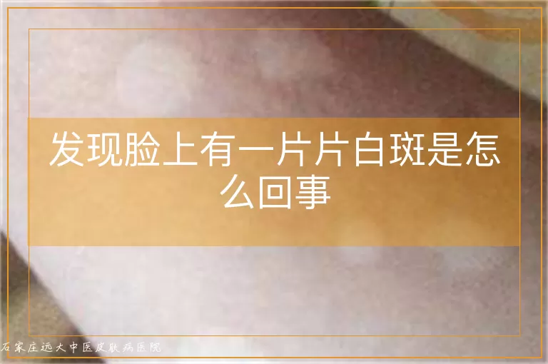 发现脸上有一片片白斑是怎么回事