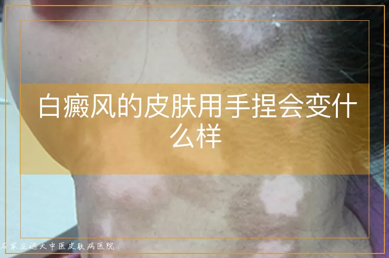 白癜风的皮肤用手捏会变什么样