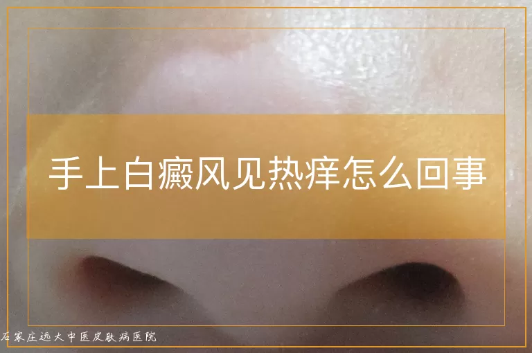手上白癜风见热痒怎么回事