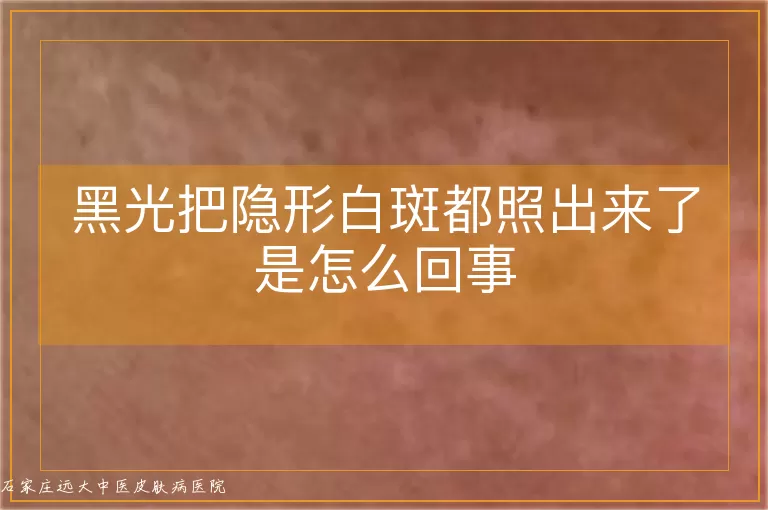 黑光把隐形白斑都照出来了是怎么回事