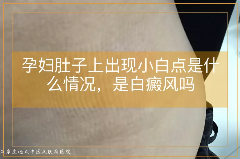 孕妇肚子上出现小白点是什么情况,是白癜风吗