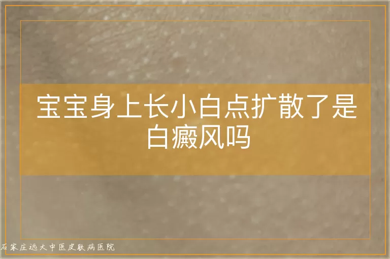 宝宝身上长小白点扩散了是白癜风吗