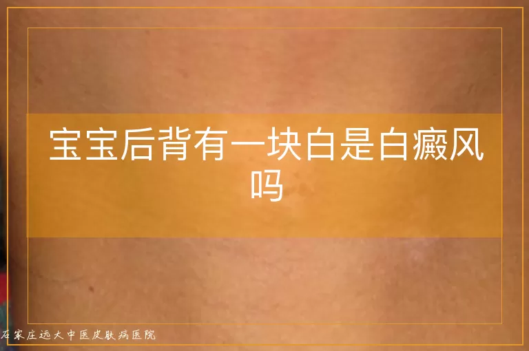 宝宝后背有一块白是白癜风吗