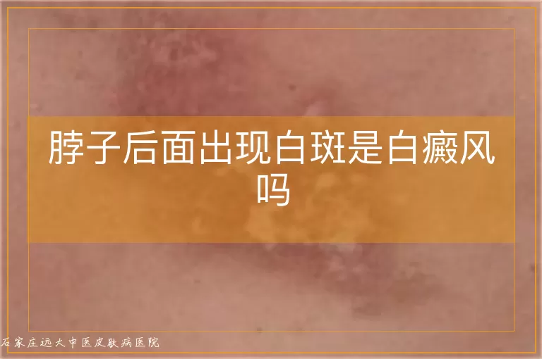 脖子后面出现白斑是白癜风吗
