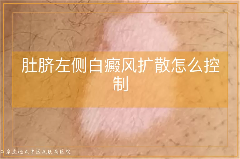 肚脐左侧白癜风扩散怎么控制