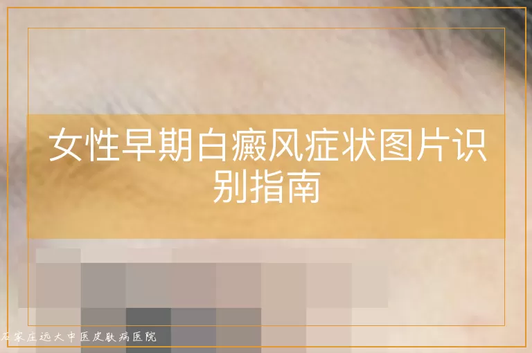 女性早期白癜风症状图片识别指南
