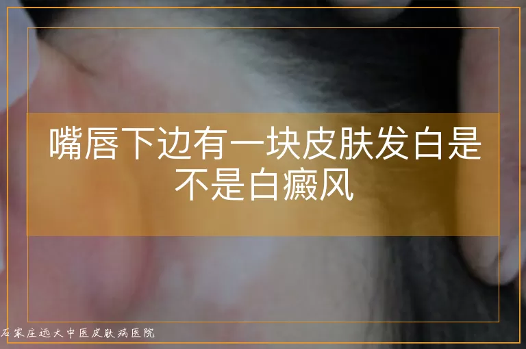 嘴唇下边有一块皮肤发白是不是白癜风