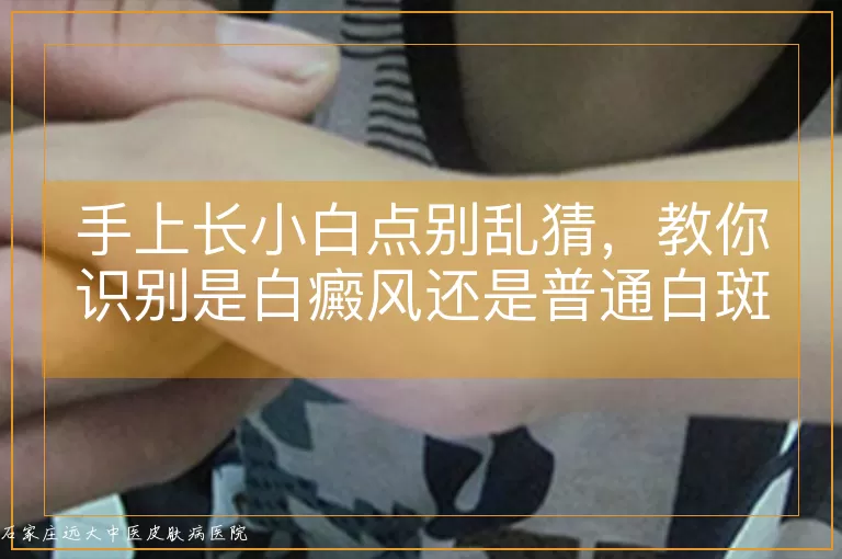 手上长小白点别乱猜，教你识别是白癜风还是普通白斑