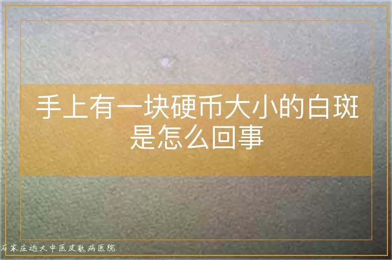 手上有一块硬币大小的白斑是怎么回事