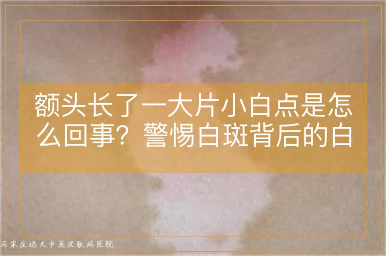 额头长了一大片小白点是怎么回事？警惕白斑背后的白癜风信号