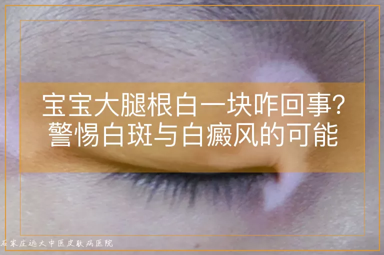 宝宝大腿根白一块咋回事?警惕白斑与白癜风的可能