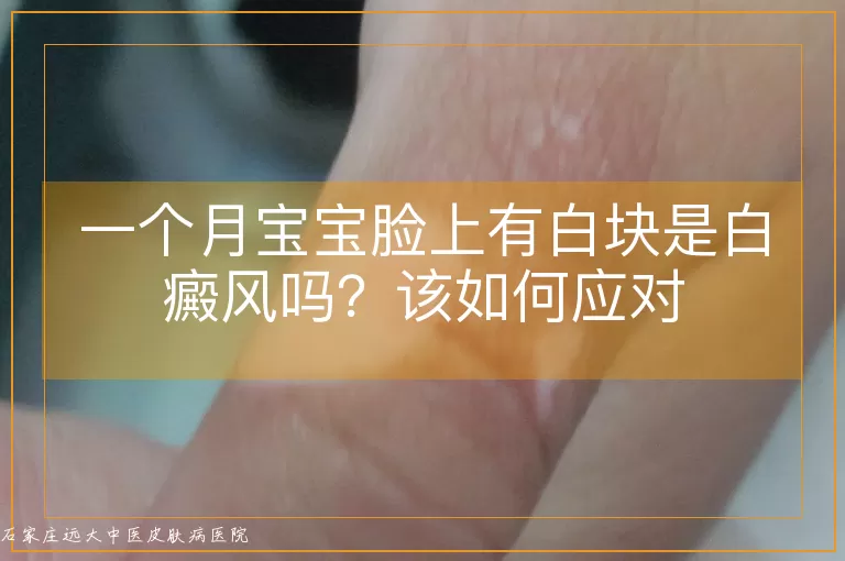 一个月宝宝脸上有白块是白癜风吗？该如何应对