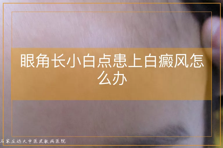 眼角长小白点患上白癜风怎么办