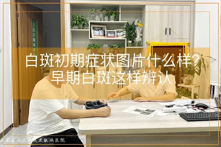 白斑初期症状图片什么样？早期白斑这样辨认