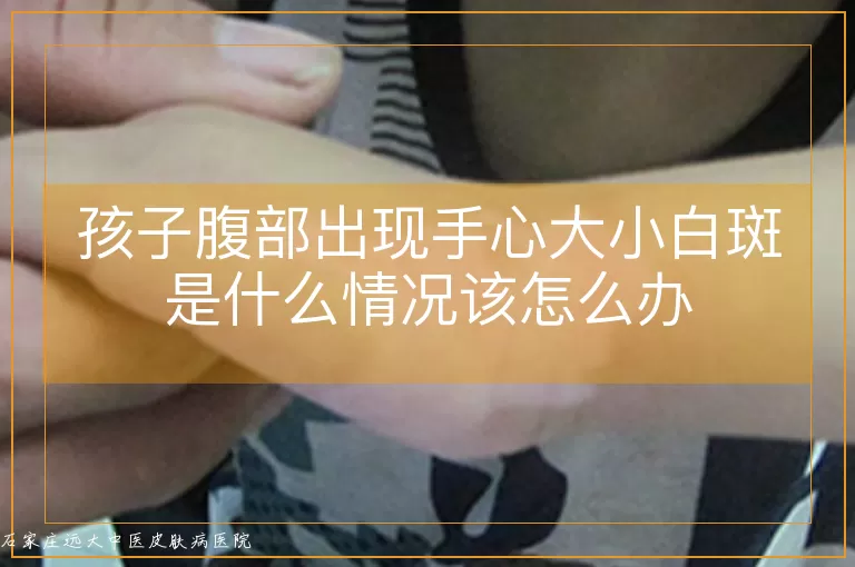 孩子腹部出现手心大小白斑是什么情况该怎么办