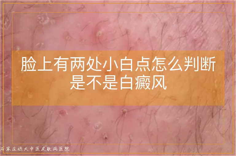 脸上有两处小白点怎么判断是不是白癜风